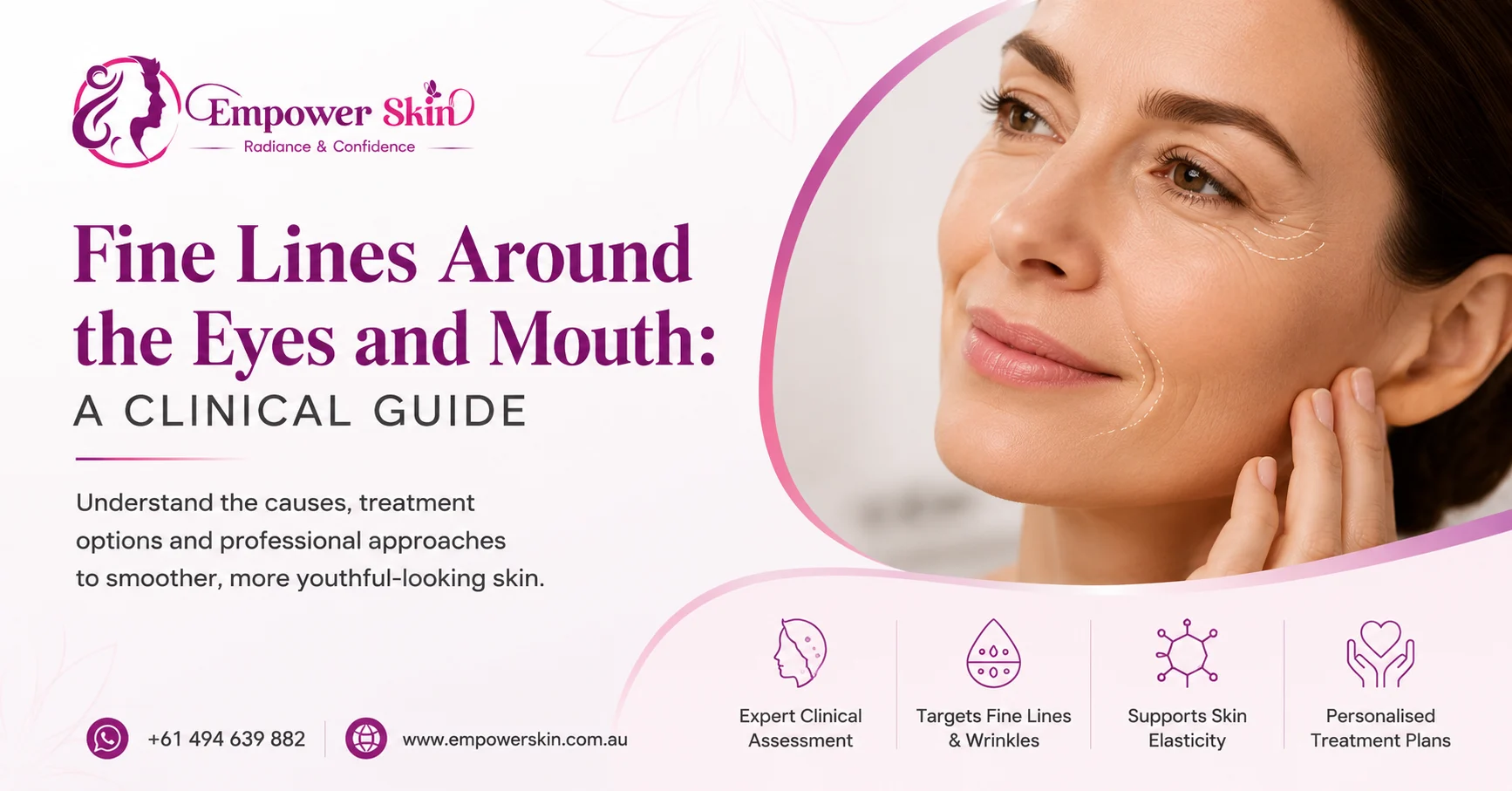 Fine Lines Around the Eyes and Mouth: A Clinical Guide