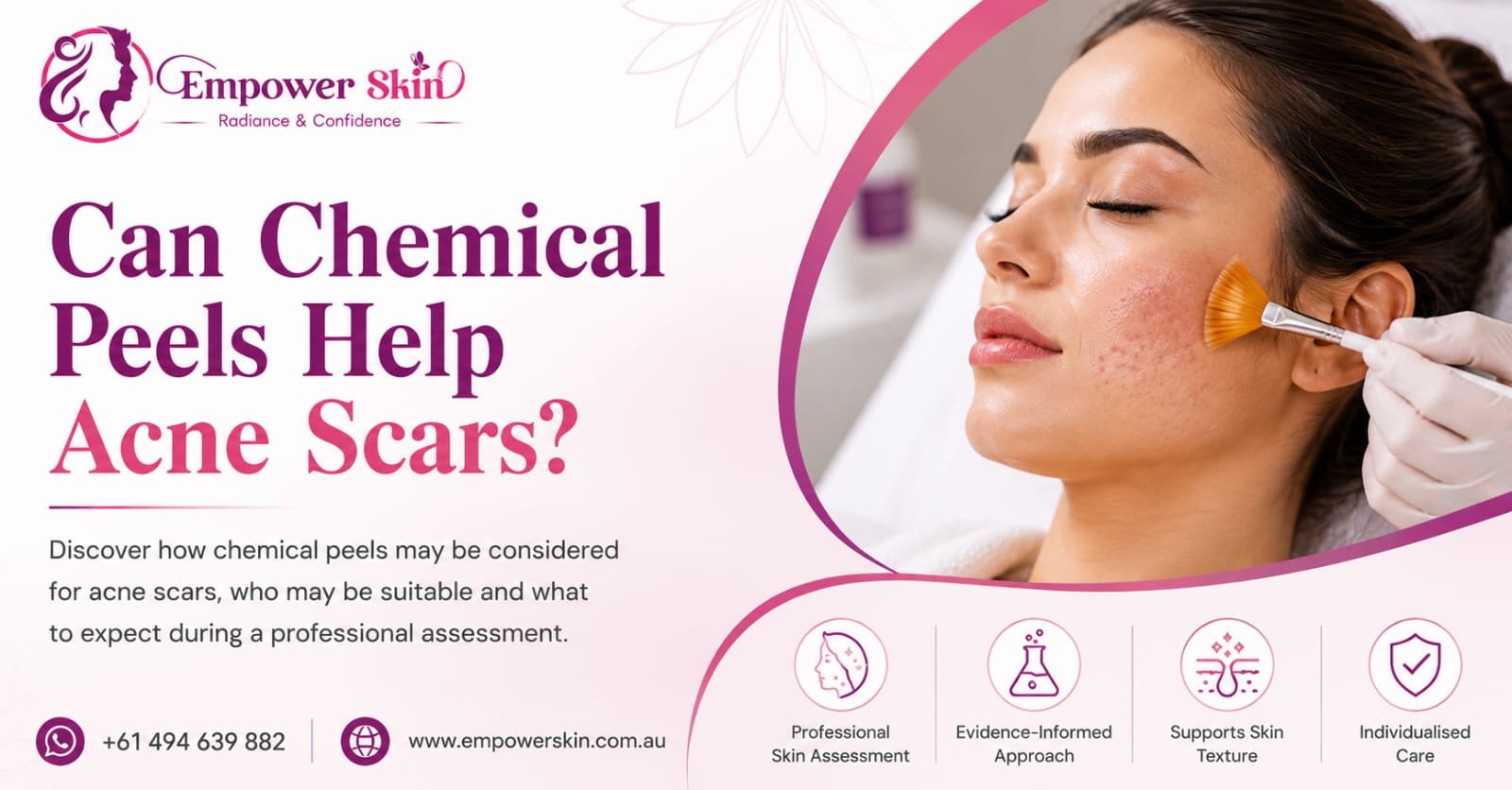 Can Chemical Peels Help Acne Scars?