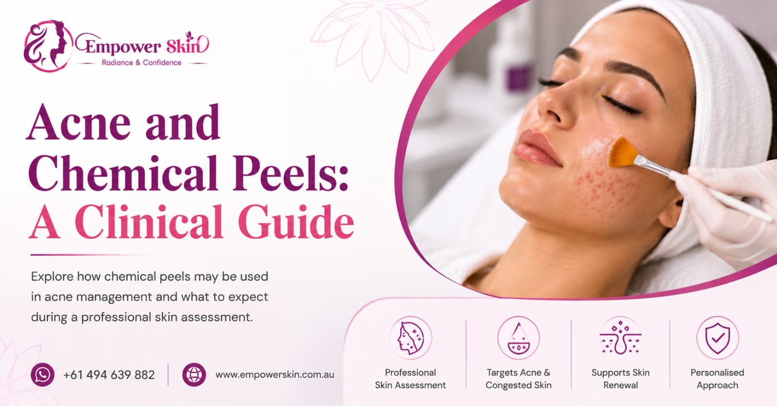Acne and Chemical Peels: A Clinical Guide