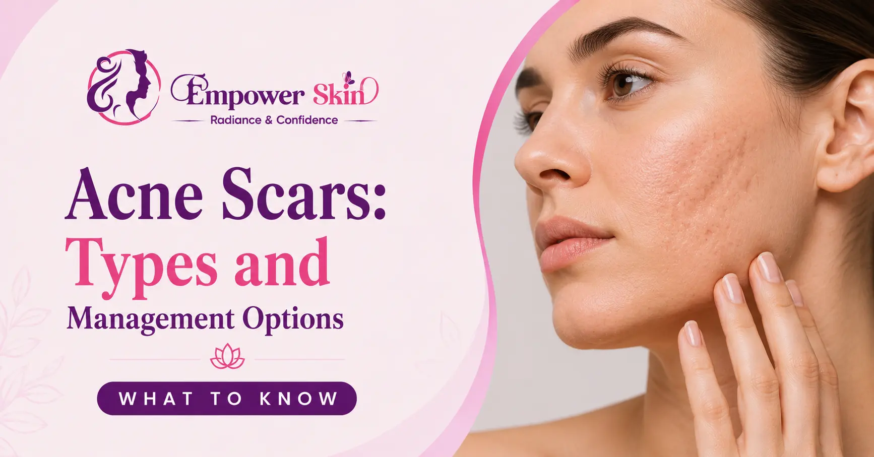 Acne Scars: Types and Management Options