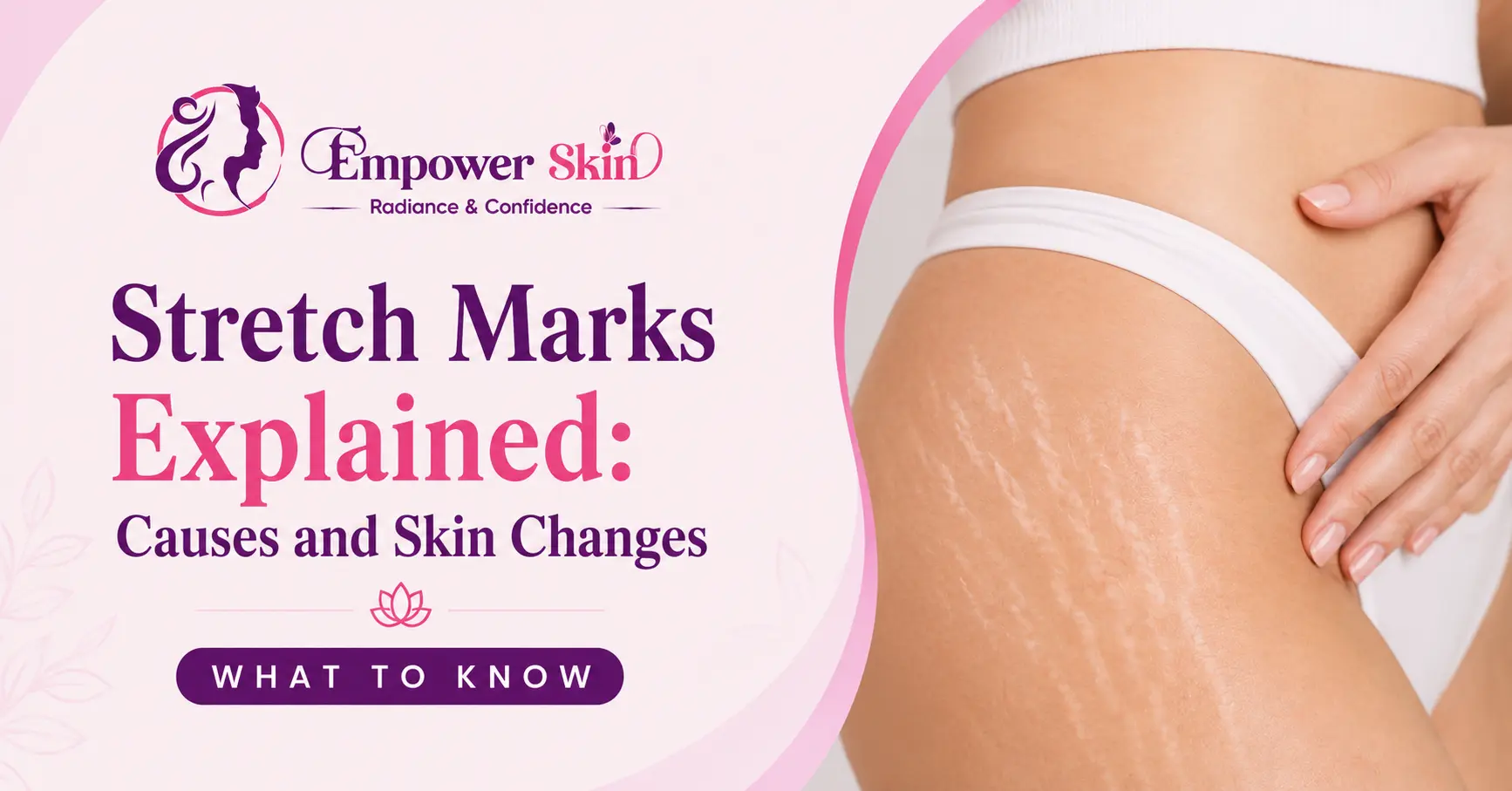 Stretch Marks Explained: Causes and Skin Changes